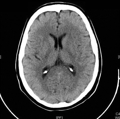 CT of head