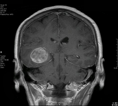 Image of coronal brain tumor