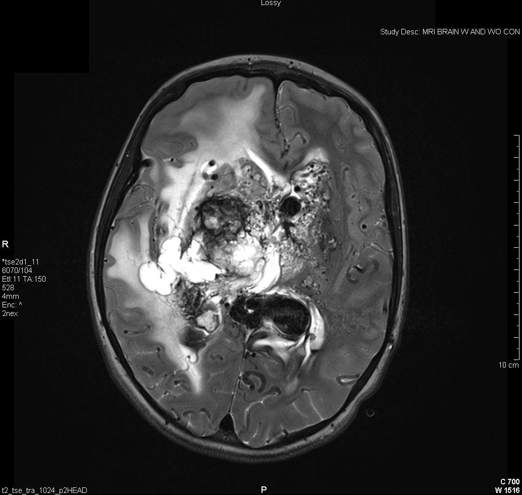 Image of arteriovenous malformation