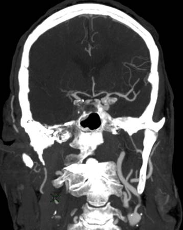 Image of blocked right middle cerebral artery causing stroke