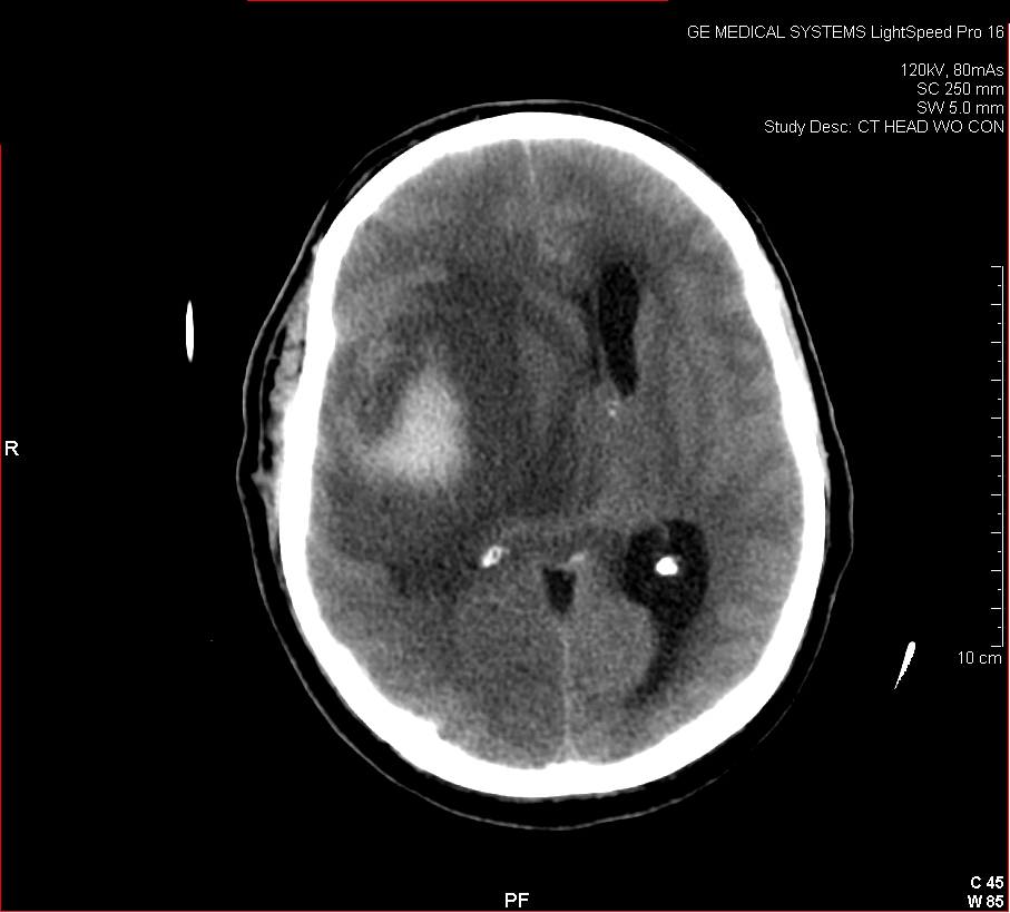 Image of Traumatic Brain Injury